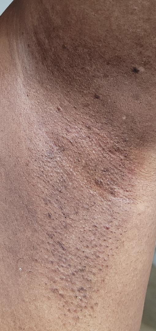 Turmeric Sugar Scrub